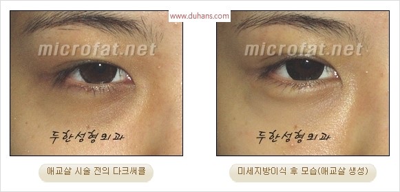 ​﻿[두한성형외과 경쟁력 지방이식] - [눈밑 애교살 시술을 위한 미세지방이식] 관련 이미지 17