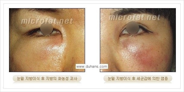 ​[두한성형외과 경쟁력 미세지방이식] - [타병원에서의 미세지방이식 부작용 종류와 문제점 안내] 관련 이미지 9