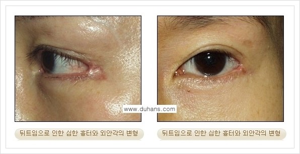 [두한성형외과 경쟁력 눈성형] - [앞트임 복원수술, 뒤트임 수술 안내] 관련 이미지 7