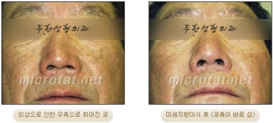[Duhan Plastic Surgery Facial Fat Grafting] - [Fat Grafting Rhinoplasty] image 11
