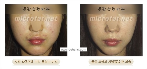 [두한성형외과 경쟁력 지방흡입] - [얼굴 지방흡입 부작용 교정방법 안내] 관련 이미지 20