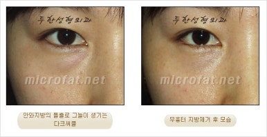 두한성형외과 눈밑수술 - 다크서클 수술 전후 관리 안내 관련 이미지 53