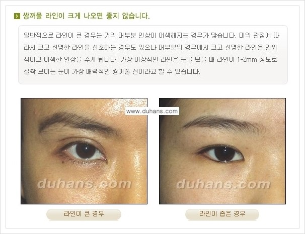 ​[두한성형외과 경쟁력 눈성형] - [자연스럽고 아름다운 쌍꺼풀의 기준] 관련 이미지 1
