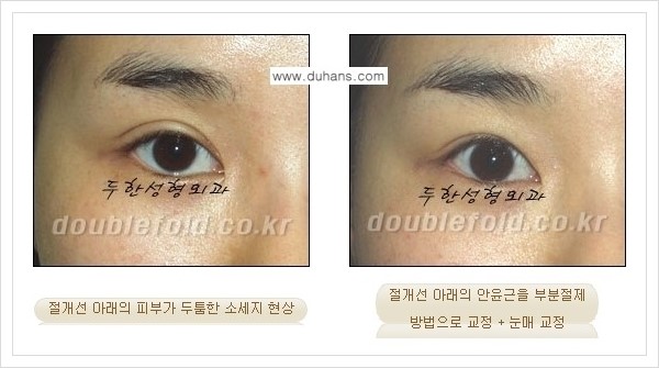 [두한성형외과 경쟁력 쌍꺼풀 재수술, 극한 재수술] - [쌍꺼풀 절개선 아래가 두툼한 소세지 쌍꺼풀의 교정 안내] 관련 이미지 5