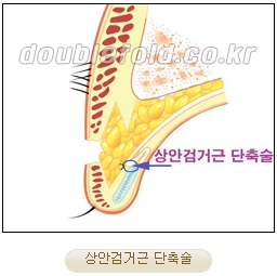 [두한성형외과 쌍커풀재수술] - [심한 소세지눈, 두줄따기, 쌍꺼풀 흉터] 관련 이미지 12