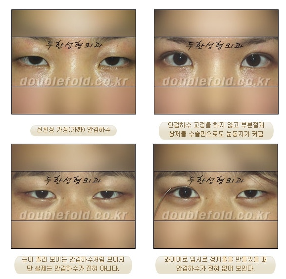 과교정 눈매 (소세지 쌍커풀 재수술, 눈매교정 재수술) 관련 이미지 7