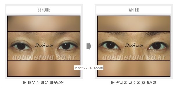 [두한성형외과 경쟁력 쌍꺼풀 재수술] - [라인이 두껍고 수술한 표시가 나는 어색한 쌍꺼풀 라인의 교정] 관련 이미지 11