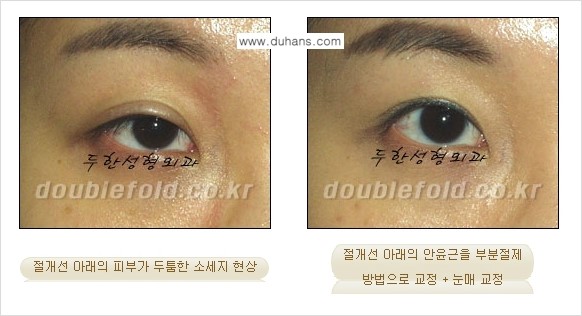 [두한성형외과 경쟁력 극한눈(쌍꺼풀)재수술] - [절개선 아래가 두툼한 소세지 쌍꺼풀 교정] 관련 이미지 8