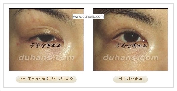 [두한성형외과 경쟁력 망가진 눈 복원수술] - [두꺼운 라인을 교정하는 극한 재수술(Extreme Reoperation) 안내] 관련 이미지 6
