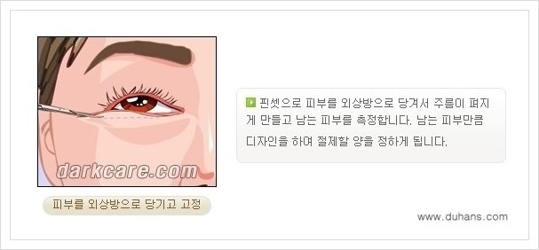 [두한성형외과 경쟁력 다크써클 치료] - [하안검 성형과 눈밑지방 재배치 안내] 관련 이미지 6