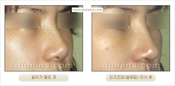 [두한성형외과 경쟁력 코성형] - [코성형을 위한 알로덤(슈어덤) 수술, 실리콘 수술 안내] 관련 이미지 15