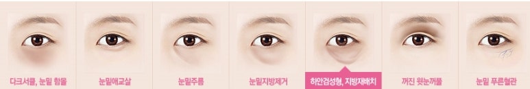 [두한성형외과 다크서클] - [다크서클 전후사진 검증] 관련 이미지 110