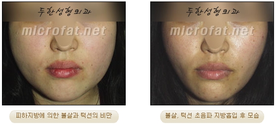 [Duhan Plastic Surgery Liposuction] - [Facial Liposuction] image 16