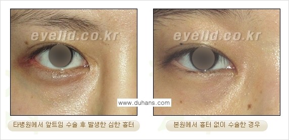 [두한성형외과 눈성형 FOCUS] - [몽고주름 제거(앞트임 제거) 수술 ③] 관련 이미지 6