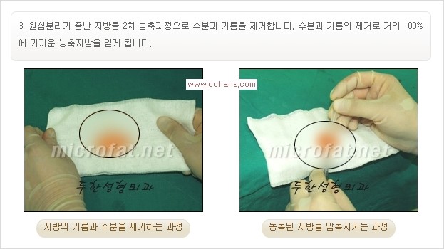 [두한성형외과 경쟁력 주름성형] - [입가와 팔자의 주름제거 지방이식 1.] 관련 이미지 5