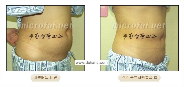 [두한성형외과 겨울엔 간편 지방흡입] - [복부, 뱃살, 아랫배, 옆구리 지방흡입 도전!] 관련 이미지 9