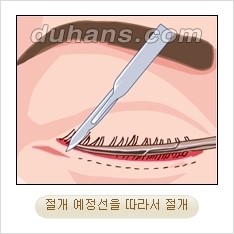 [두한성형외과 경쟁력 동안성형 리더] - ​[미간주름, 이마주름, 안검성형, 이마거상술, 눈썹거상술] 관련 이미지 60