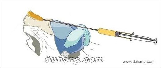 [두한성형외과 경쟁력 미세지방이식] - [코 미세지방이식 안내] 관련 이미지 1
