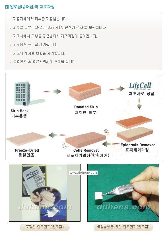 [두한성형외과 경쟁력 코성형] - [코성형을 위한 알로덤(슈어덤) 수술, 실리콘 수술 안내] 관련 이미지 3