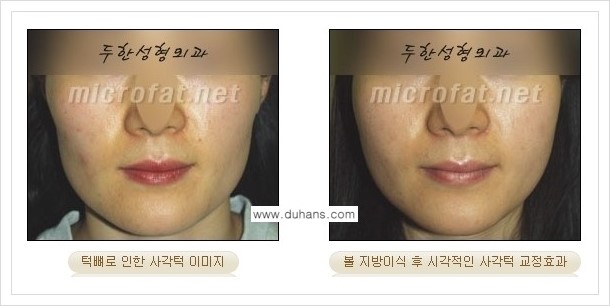 [두한성형외과 경쟁력 볼살지방이식] - [사각턱의 경우, 측면 볼살의 함몰선, 안면비대칭, 남성 야윈볼살 안내] 관련 이미지 2