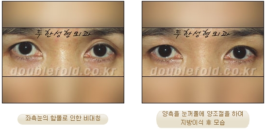 두한성형외과 쌍커풀 재수술 - 짝눈 눈매교정, 가성 안검하수 교정과 뒤밑트임 관련 이미지 18