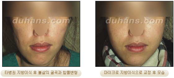 [두한성형외과 얼굴자가지방이식] - [볼살, 이마, 측두부] 관련 이미지 37