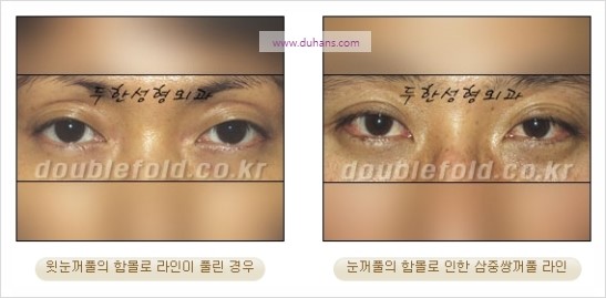 [두한성형외과 경쟁력 눈성형] - [눈꺼풀이 꺼진 경우의 쌍꺼풀 라인을 교정하기 위한 미세지방이식] 관련 이미지 3