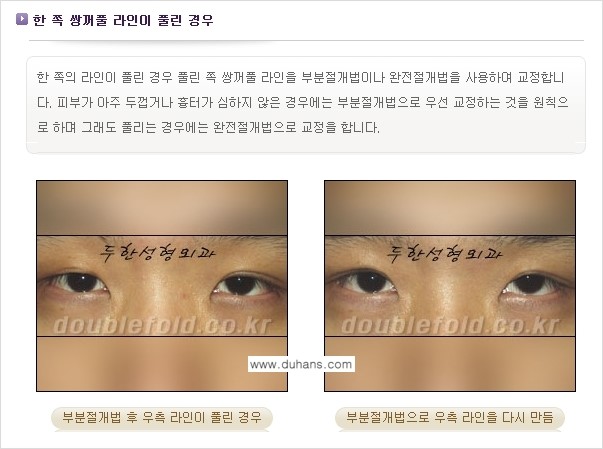 [두한성형외과 경쟁력 눈성형] - [비대칭(짝짝이) 쌍꺼풀 라인 교정 안내 ②] 관련 이미지 2