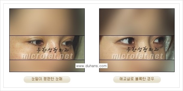 [두한성형외과 경쟁력 눈밑성형] - [눈밑 다크써클과 눈밑 애교살과의 관계] 관련 이미지 1