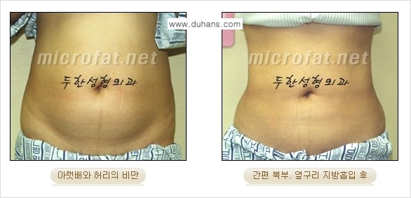 [두한성형외과 겨울엔 지방흡입] - [간편한 복부지방흡입 도전 2.] 관련 이미지 6