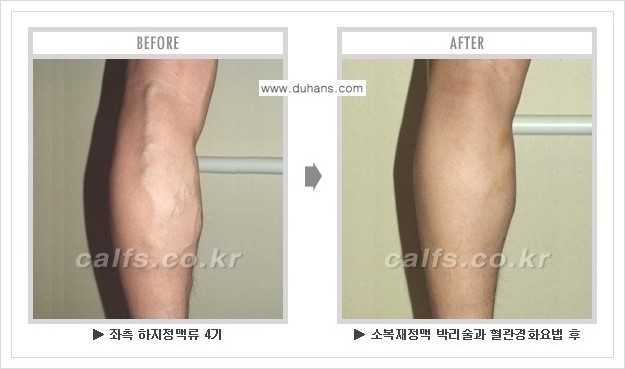 [두한성형외과 경쟁력 정맥류 치료] - [하지정맥류 사진 자료 안내 1.] 관련 이미지 4