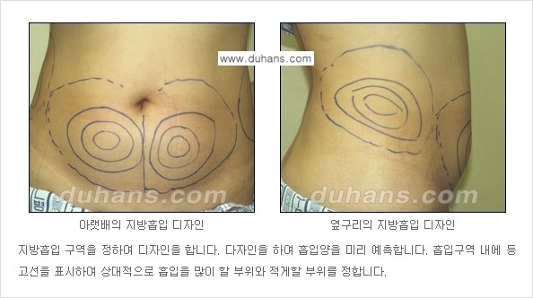 [두한성형외과 경쟁력 간편지방흡입] - [복부(뱃살) 비만 간편지방흡입] 관련 이미지 8