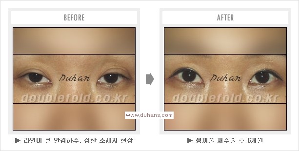 [두한성형외과 경쟁력 쌍꺼풀 재수술, 극한 눈재수술] - [두툼한 소세지 쌍꺼풀 라인 교정] 관련 이미지 12