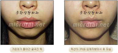 [Duhan Plastic Surgery Clinic Microgenia Correction] - [Chin Microfat Grafting] image 17