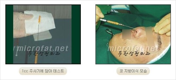 [두한성형외과 경쟁력 코성형 리더] - [자연스럽고 오똑한 콧망울! 코성형 방법]​ 관련 이미지 43