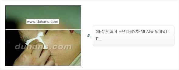[두한성형외과 젊어지는 주름교정술] - [주름제거 시술방법 ④] 관련 이미지 8