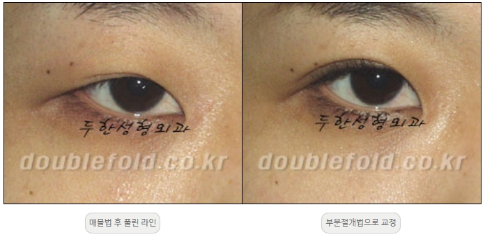 [두한성형외과 쌍커풀재수술] - [풀린 쌍커풀라인 교정] 관련 이미지 11