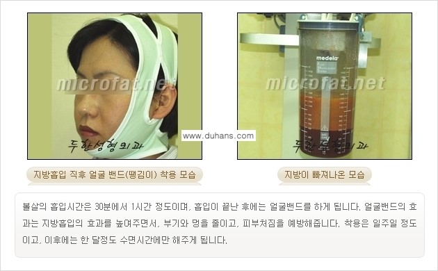 [두한성형외과 경쟁력 지방흡입] - [얼굴 지방흡입 부작용 교정방법 안내] 관련 이미지 10