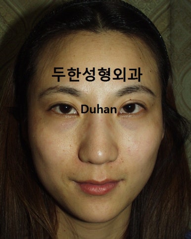 [두한성형외과 다크서클] - [다크서클 콜펫지방이식] 관련 이미지 43