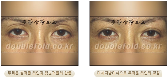 [Eye Reoperation Duhan Plastic Surgery] - [Guide to Double Eyelid Revision Surgery] image 45