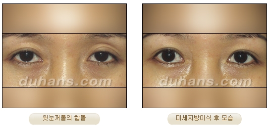 [Duhan Plastic Surgery Micro Fat Grafting] - [Upper Eyelids] image 13
