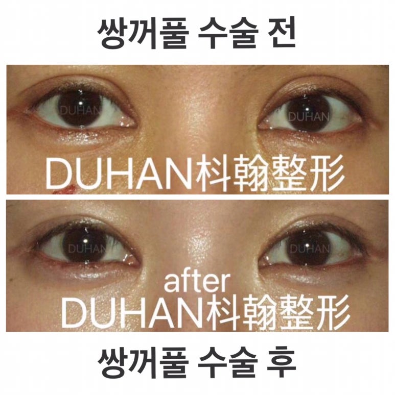 쌍꺼풀 재수술 관련 이미지 1
