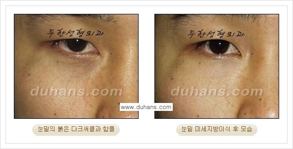 [두한성형외과 경쟁력 눈밑성형] - [꺼진 눈밑, 눈밑 함몰 주름선 눈밑 미세지방이식 안내] 관련 이미지 8