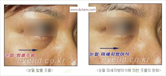 [두한성형외과 경쟁력 눈밑성형] - [눈밑 다크써클 수술 방법] 관련 이미지 13