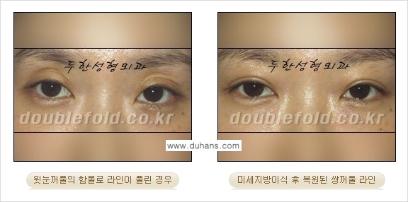 [두한성형외과 경쟁력 눈성형] - [미세지방이식으로 풀린 라인의 교정 방법 안내] 관련 이미지 7