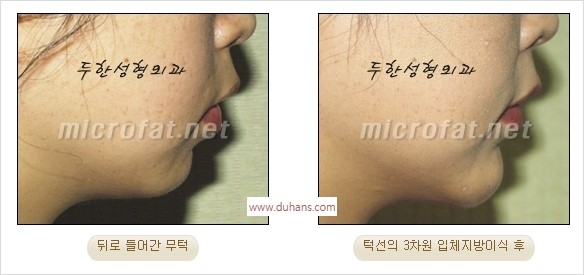 [두한성형외과 경쟁력 안면윤곽 교정] - [자연스럽고 균형있는 턱으로의 복원 미세지방이식과 간편 사각턱 보톡스 안내] 관련 이미지 23