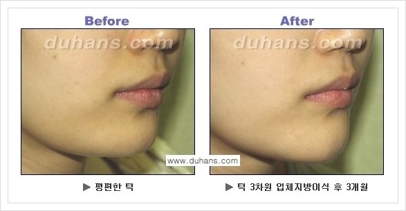 [두한성형외과 경쟁력 미세지방이식] - [아름다운 얼굴선 - 무턱, 오목턱, 비대칭턱 지방이식 안내] 관련 이미지 16