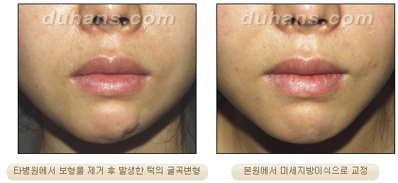 [Duhan Plastic Surgery Micro Fat Grafting] - [Receded Chin, Small Chin, Cleft Chin, Chin Line Asymmetry Correction] image 5