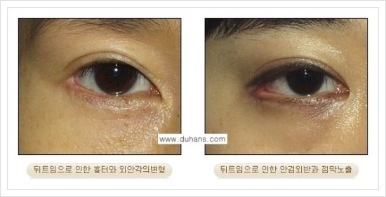 ​[두한성형외과 경쟁력 눈매성형] - [눈의 가로길이를 키우는 앞트임, 뒤트임 수술] 관련 이미지 23