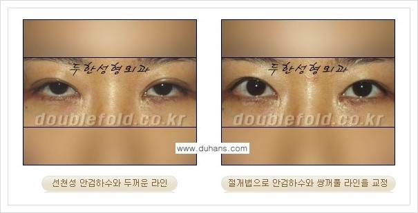 [두한성형외과 경쟁력 쌍꺼풀 재수술, 극한 눈 재수술] - [안검하수(졸리운 눈매) 재수술 안내] 관련 이미지 4